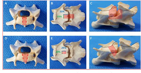 Ventral Slot De Recuperacao